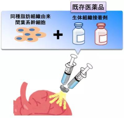 干細(xì)胞噴霧 大阪大學(xué)為心衰患者點亮新曙光
